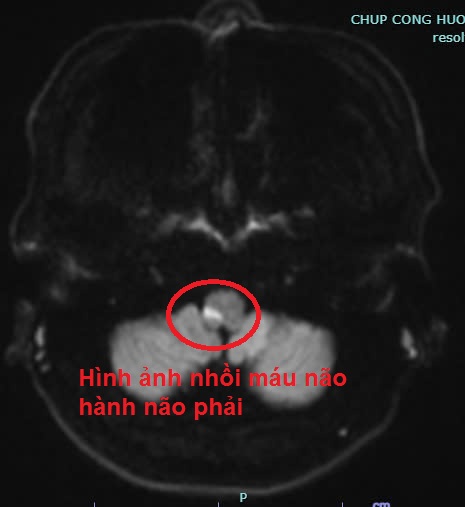 Đột quỵ não sau khi uống rượu, nguy kịch phải nhập viện